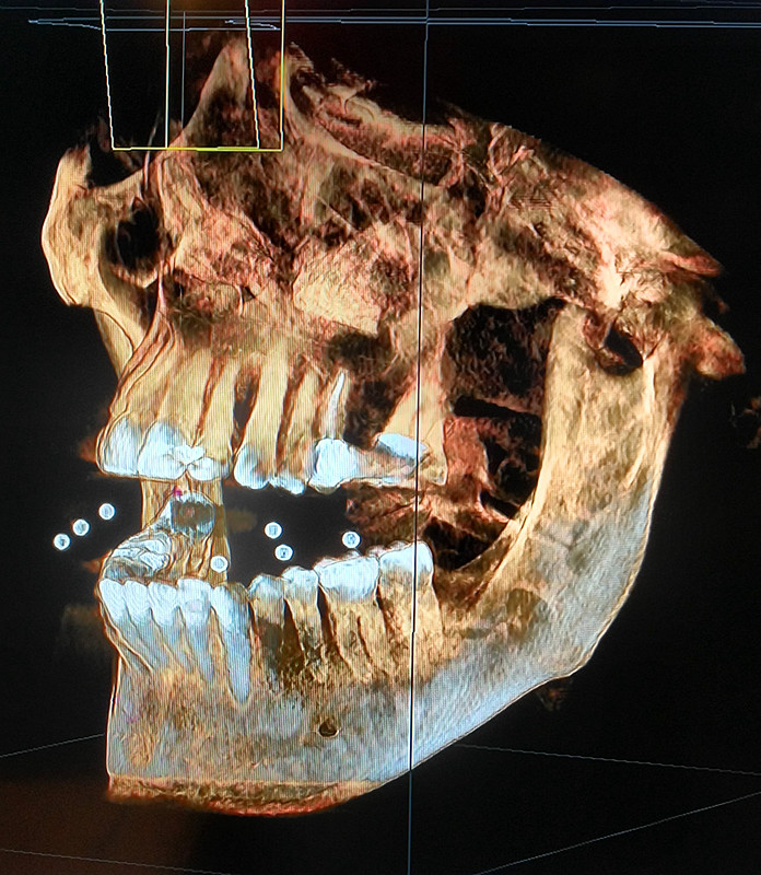 que es un tac dental