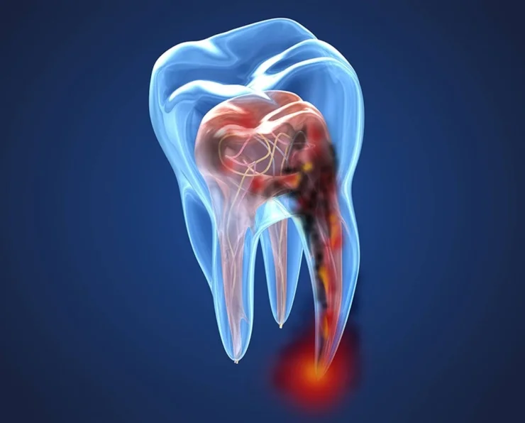 endodoncia y pulpitis