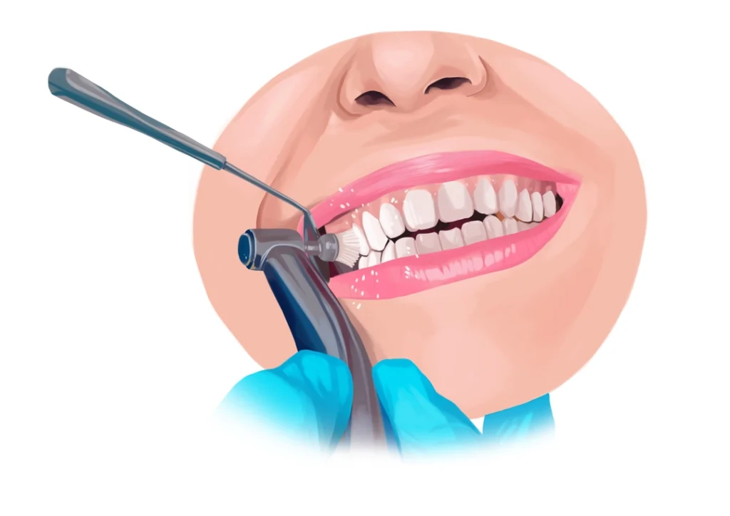 periodontitis