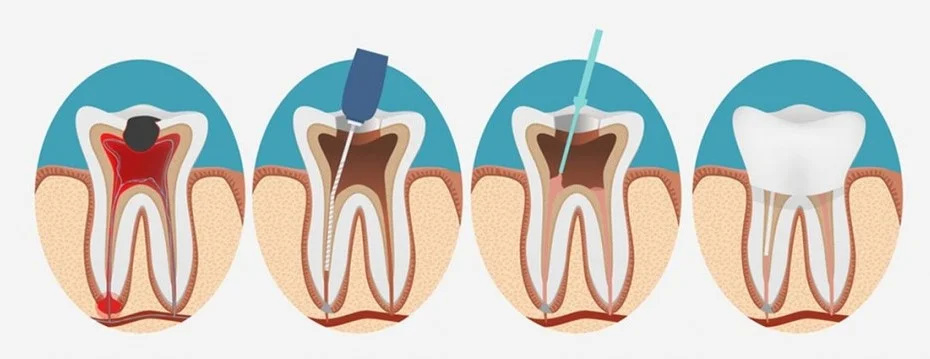 endodoncia y pulpitis