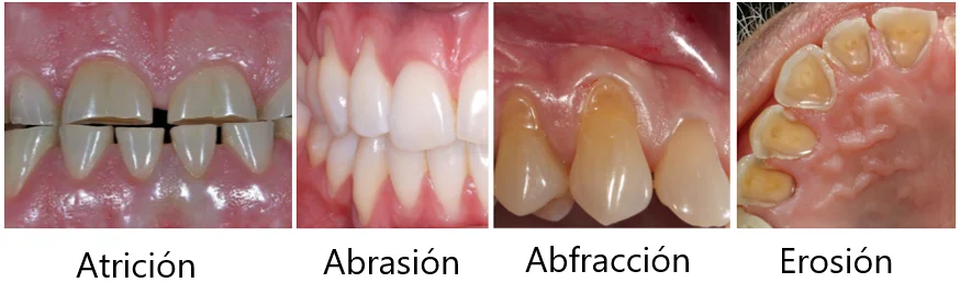 desgaste dental