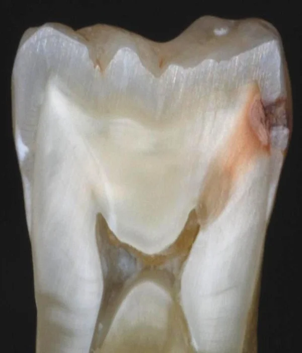 caries