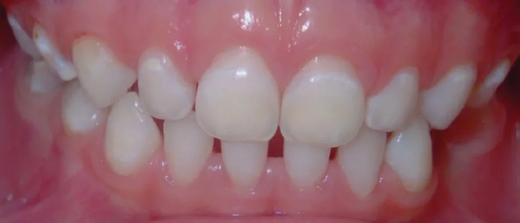 caries infantil