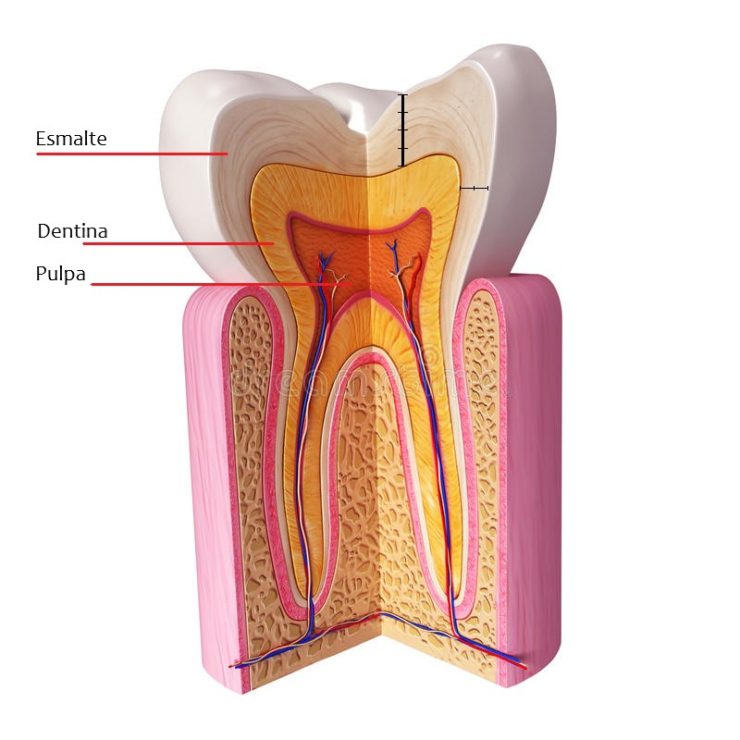 caries interdental