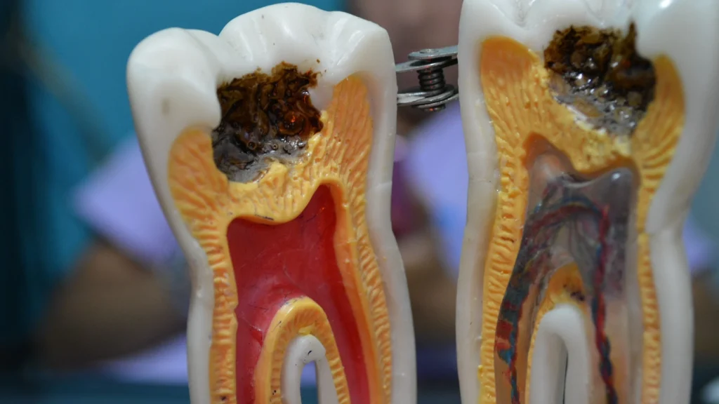 caries