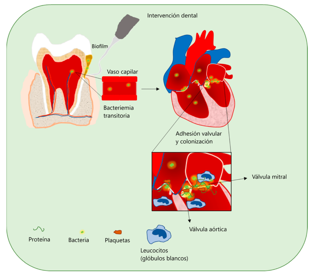 endocarditis