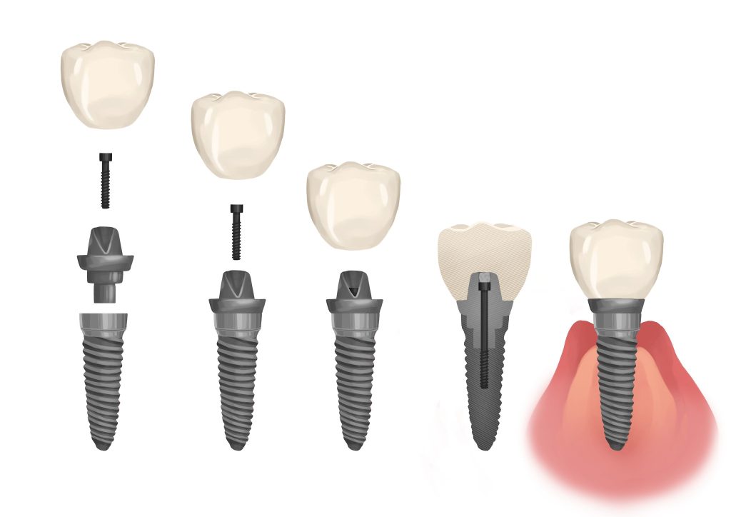 proceso de los implantes dentales