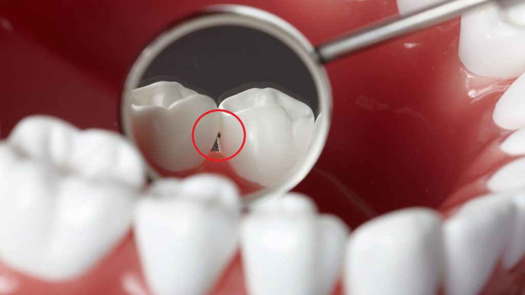 caries interdental